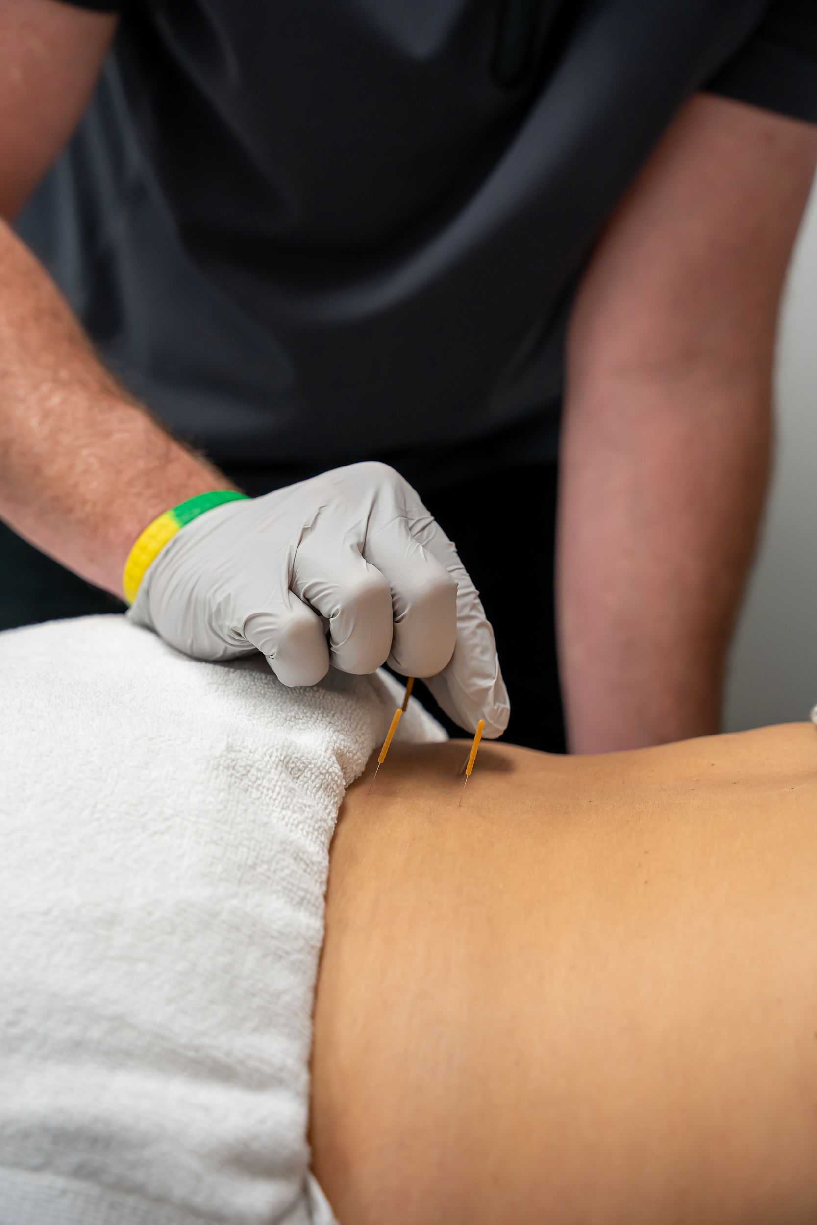 Dry Needling Therapy